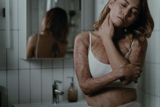 Як отримати безкоштовне лікування опіків в Україні - проект Неопалимі
