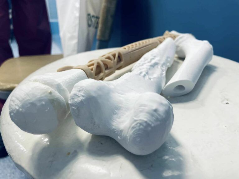 У Львові онкохворому хлопчику пересадили кістку, надруковану на 3D-принтері