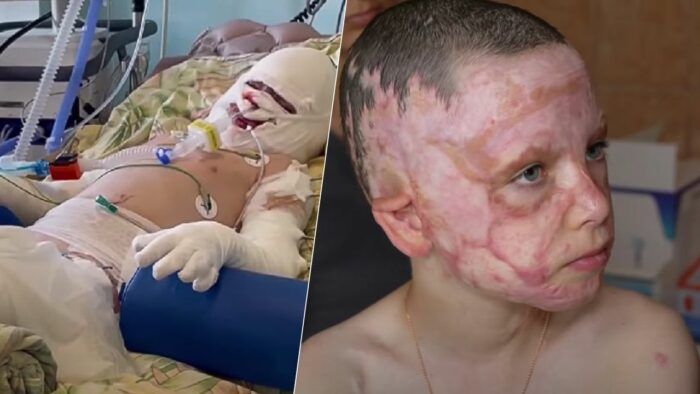 Вижив попри сильну травму! Восьмирічний Ромчик продовжує реабілітацію