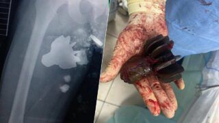 Врятував бійця з хвостовиком міни у нозі: історія порятунку військового