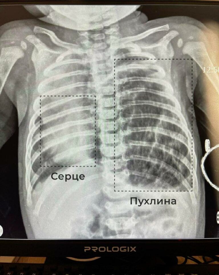 Фото 1 до: Історія Варвари, яку врятували від небезпечної пухлини