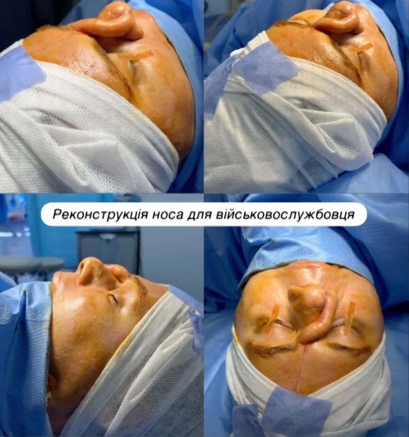 Відновлення носа військовому