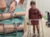 Ламають та витягують кістки: як живуть діти з низькорослістю в Україні