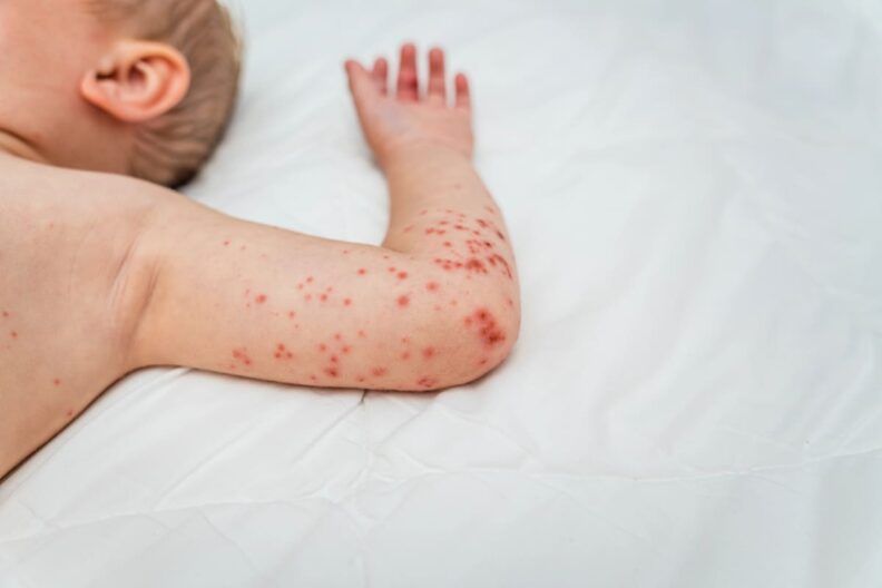 вірус коксакі