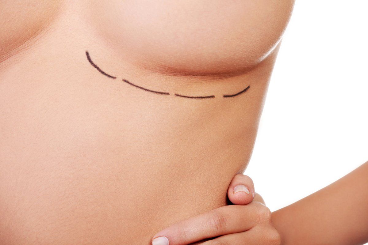 Фото к: Когда женщинам лучше делать маммопластику: советы пластического хирурга