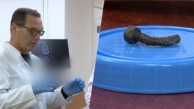 Фото к: Нейрохирурги из Днепра 5 часов доставали обломок из черепа раненого бойца